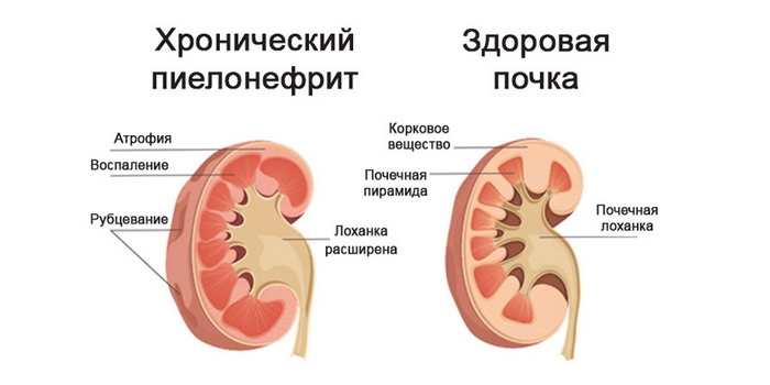 Пиелонефрит у женщин - причины, симптомы и лечение