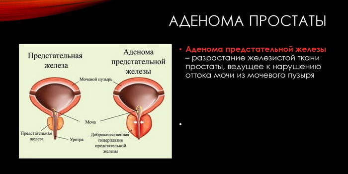 Что такое аденома предстательной железы, какие бывают степени и стадии